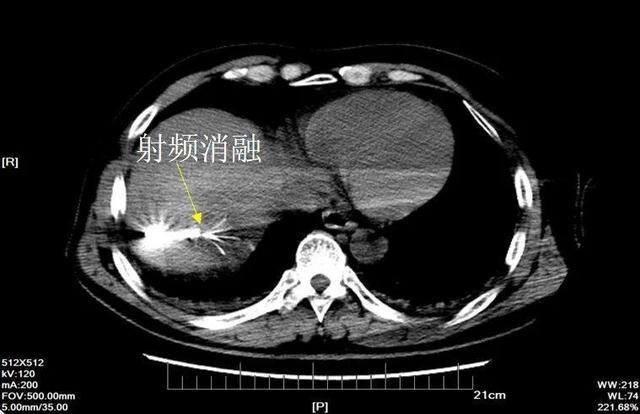 要的就是精準(zhǔn)！手術(shù)無法切除腫瘤，這項“黑科技”為他帶來希望......